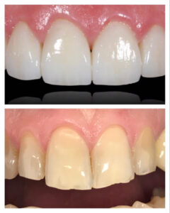 Clínica dental en Madrid vfclinic, especialistas en implantes, ortodoncia y estética dental