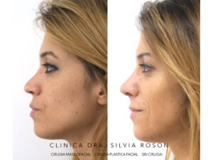 Dra Silvia Rosón. Rinoplastia Ulrasonica. Rinoseptoplastia. Cirugia Maxilofacial. Medicina Estetica Facial. Cirugia Estetica Facial.