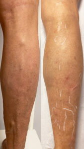 Clínica Madrid Vascular. Tratamientos de varices sin cirugía, Hemorroides, Úlceras, medicina estética Madrid. Dr. Chocrón.
