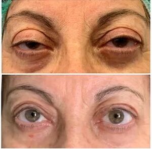 Blefaroplastia en Madrid y Cirugía de Parpados - Clínica Jiménez Ortiz