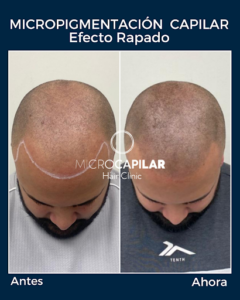 MICROCAPILAR HAIR CLINIC