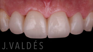 Clínica Dental Navarro Madrid - Dentistas - Implantes dentales