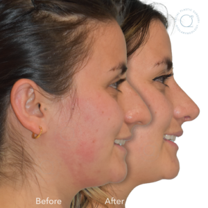 Clínicas Duque - Rinoplastia SIN cicatriz