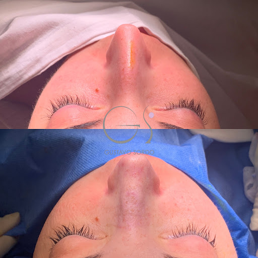 Dr. Gustavo Sordo. Rinoplastia Ultrasónica y Aumento de Pecho en Madrid