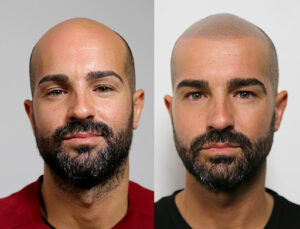 Aldemar Campos Micropigmentation