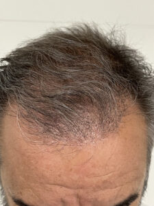 Clínica Adcure Cirugía Estética Madrid, Injerto capilar, tratamientos capilares y medicina estética