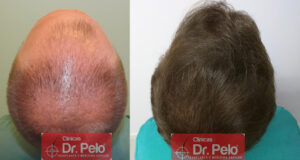 Clinicas Dr. Pelo - Madrid - Injerto Capilar